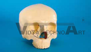Skull, with holder, fractured